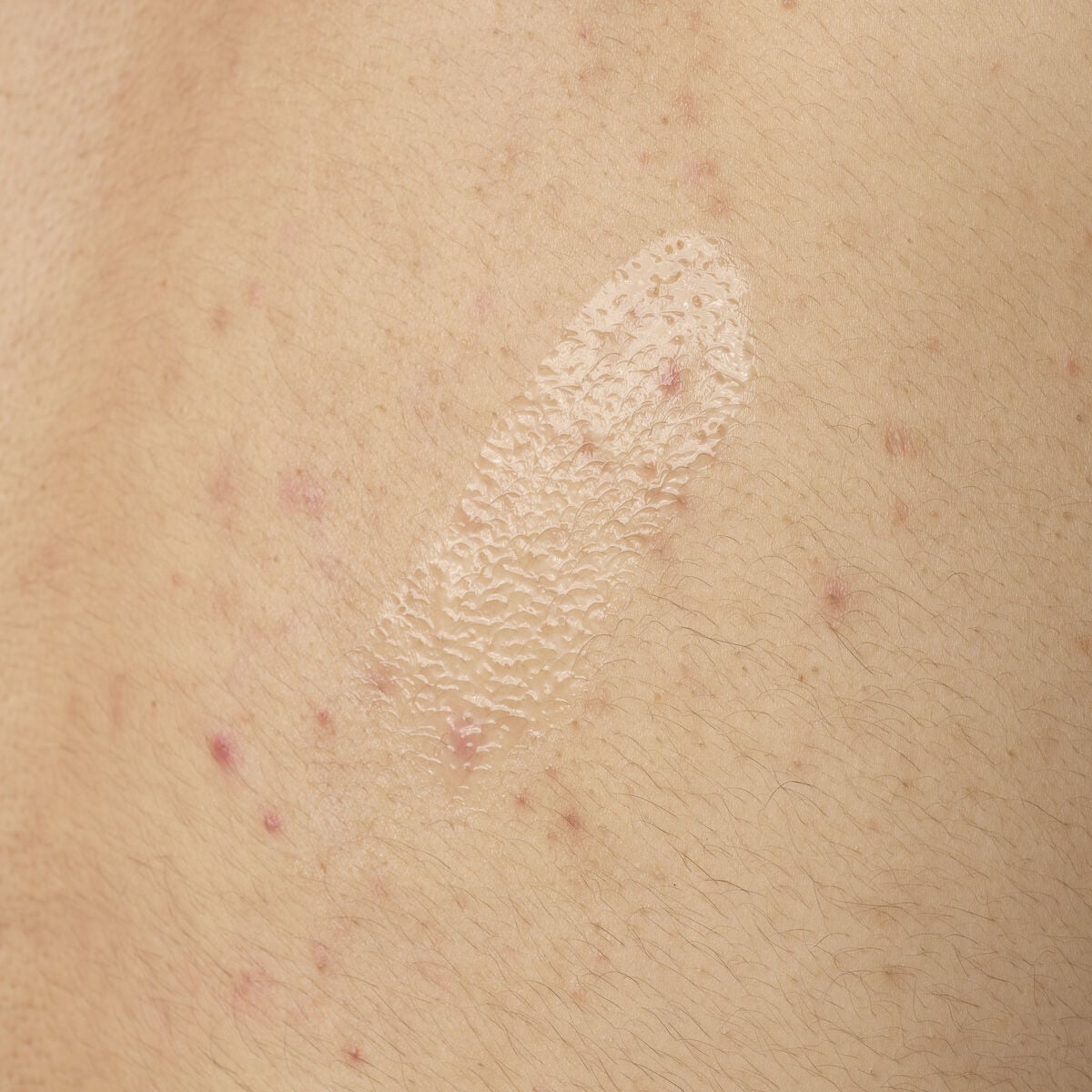 Close-up texture shot of The Ordinary Salicylic Acid 0.5% Body Serum. The clear, lightweight gel is shown applied directly to skin with some visible body acne, demonstrating its consistency.